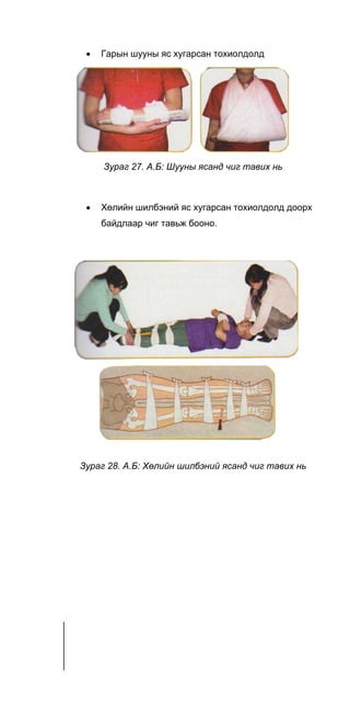 • Гарын шууны яс хугарсан тохиолдолд
Зураг 27. А.Б: Шууны ясанд чиг тавих нь
• Хөлийн шилбэний яс хугарсан тохиолдолд доорх
байдлаар чиг тавьж бооно.
Зураг 28. А.Б: Хөлийн шилбэний ясанд чиг тавих нь
 