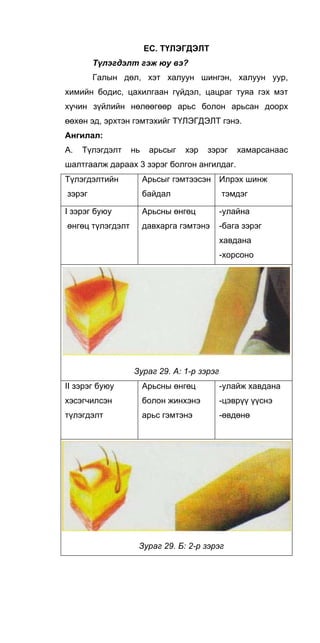 EC. ТҮЛЭГДЭЛТ
Түлэгдэлт гэж юу вэ?
Галын дөл, хэт халуун шингэн, халуун уур,
химийн бодис, цахилгаан гүйдэл, цацраг туяа гэх мэт
хүчин зүйлийн нөлөөгөөр арьс болон арьсан доорх
өөхөн эд, эрхтэн гэмтэхийг ТҮЛЭГДЭЛТ гэнэ.
Ангилал:
А. Түлэгдэлт нь арьсыг хэр зэрэг хамарсанаас
шалтгаалж дараах 3 зэрэг болгон ангилдаг.
Түлэгдэлтийн
зэрэг
Арьсыг гэмтээсэн
байдал
Илрэх шинж
тэмдэг
I зэрэг буюу
өнгөц түлэгдэлт
Арьсны өнгөц
давхарга гэмтэнэ
-улайна
-бага зэрэг
хавдана
-хорсоно
Зураг 29. А: 1-р зэрэг
II зэрэг буюу
хэсэгчилсэн
түлэгдэлт
Арьсны өнгөц
болон жинхэнэ
арьс гэмтэнэ
-улайж хавдана
-цэврүү үүснэ
-өвдөнө
Зураг 29. Б: 2-р зэрэг
 