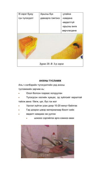 III зэрэг буюу
гүн түлэгдэлт
Арьсны бүх
давхарга гэмтэнэ
-улайна
-хавдана
-өвдөлтгүй
-арьсны өнгө
өөрчлөгдөнө
Зураг 29. В: 3-р зэрэг
АНХНЫ ТУСЛАМЖ
Аль ч хэлбэрийн түлэгдэлтийн үед анхны
тусламжийн зарчим нь:
• Осол болсон газраас холдуулан
• Түлэгдсэн хэсгийн хувцас, эд зүйлсийг яаралтай
тайлж авна / бөгж, цаг, бүс гэх мэт
• Урсгал хүйтэн усан доор 10-20 минут байлгах
• Гар доорхи цэвэр материалаар боолт хийх
• өвдөлт намдаах эм уулгах
• шокоос сэргийлэх арга хэмжээ авах
 