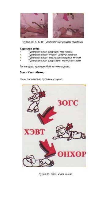 Зураг 30. А. Б. В: Түлэгдэлтэнд үзүүлэх тусламж
Хориглох зүйл:
• Түлэгдсэн хэсэг дээр цас, мөс тавих.
• Түлэгдсэн хэсэгт үүссэн цэвруүг хагалах
• Түлэгдсэн хэсэгт наалдсан хувцасыг хуулах
• Түлэгдсэн хэсэг дээр хөвөн материал тавих
Галын дөлд түлэгдэж байгаа тохиолдолд:
Зогс - Хэвт - Өнхөр
гэсэн дарааллаар тусламж үзүүлнэ.
Зураг 31. Зогс, хэвт, өнхөр
 