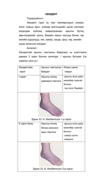 ХӨЛДӨЛТ
Тодорхойлолт:
Хөлдөлт гэдэг нь нам температурын улмаас
хэсэг газрын арьс, улмаар эрхтнүүдийн цусан хангамж
алдагдаж хүйтэнд хайрагдсанаас арьсны бүтэц
өөрчлөгдөхийг хэлнэ. Биеийн захын хэсгүүд болох гар
хөлийн хуруунууд, чих, хамар, хацар, эрүү, гар, хөлийн
үзүүр ихэвчлэн хөлддөг.
Ангилал :
Хөлдөлтийг арьсыг гэмтээсэн байдлаас нь шалтгаалж
дараах 3 зэрэг болгон ангилдаг. / арьсны бүтцийг 5-р
сэдвээс үзнэ үү /
Хөлдөлтийн
зэрэг
Арьсыг гэмтээсэн
байдал
Илрэх шинж
тэмдэг
I зэрэг Арьсны өнгөц
давхарга гэмтэнэ
-арьсны өнгө цайж,
хөхөлбөр туяатай
болсон
-тэр хэсэг бадайрч
Зураг 33. А: Хөлдөлтийн 1-р зэрэг
II зэрэг буюу Арьсны өнгөц
болон жинхэнэ
арьс гэмтэнэ
-арьсны өнгө цайж,
хөхөлбөр туяатай
болсон
-цэврүү үүснэ
-хавдана
Зураг 33. Б: Хөлдөлтийн 2-р зэрэг
 