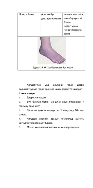 III зэрэг буюу Арьсны бүх
давхарга гэмтэнэ
-арьсны өнгө цайж,
хөхөлбөр туяатай
болсон
-цэврүү үүснэ
-чинэрч мэдээгүй
болно
Зураг 33. В: Хөлдөлтийн 3-р зэрэг
Хөлдөлтийн үед арьсанд гарах дээрх
өөрчлөлтүүдээс гадна ерөнхий шинж тэмдгүүд илэрдэг.
Шинж тэмдэг:
1. Даарч, чичирсэн.
2. Бүх биеийн болон мөчдийн арьс биржийсэн /
галууны арьс шиг/.
3. Судасны цохилт олширсон /1 минутанд 80- аас
дээш /.
4. Хөлдсөн хэсгийн арьсыг тэмтрэхэд хүйтэн,
хатуурч зузаарсан мэт байна.
5. Мөчид хөлдвөл хөдөлгөөн нь хязгаарлагдана.
 