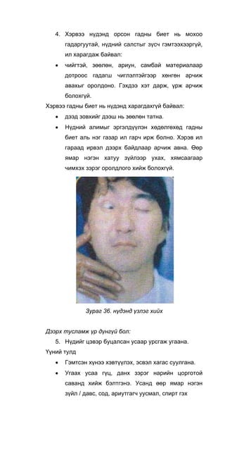 4. Хэрвээ нүдэнд орсон гадны биет нь мохоо
гадаргуутай, нүдний салстыг зүсч гэмтээхээргүй,
ил харагдаж байвал:
• чийгтэй, зөөлөн, ариун, самбай материалаар
дотроос гадагш чиглэлтэйгээр хөнгөн арчиж
авахыг оролдоно. Гэхдээ хэт дарж, үрж арчиж
болохгүй.
Хэрвээ гадны биет нь нүдэнд харагдахгүй байвал:
• дээд зовхийг дээш нь зөөлөн татна.
• Нүдний алимыг эргэлдүүлэн хөдөлгөхөд гадны
биет аль нэг газар ил гарч ирж болно. Хэрэв ил
гараад ирвэл дээрх байдлаар арчиж авна. Өөр
ямар нэгэн хатуу зүйлээр ухах, хямсаагаар
чимхэх зэрэг оролдлого хийж болохгүй.
Зураг 36. нүдэнд үзлэг хийх
Дээрх тусламж үр дүнгүй бол:
5. Нүдийг цэвэр буцалсан усаар урсгаж угаана.
Үүний тулд
• Гэмтсэн хүнээ хэвтүүлэх, эсвэл хагас суулгана.
• Угаах усаа гүц, данх зэрэг нарийн цорготой
саванд хийж бэлтгэнэ. Усанд өөр ямар нэгэн
зүйл / давс, сод, ариутгагч уусмал, спирт гэх
 