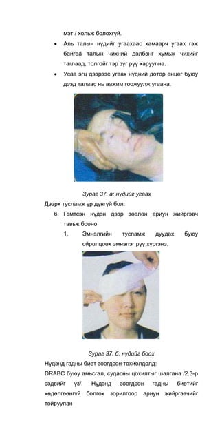 мэт / хольж болохгүй.
• Аль талын нүдийг угаахаас хамаарч угаах гэж
байгаа талын чихний дэлбэнг хумьж чихийг
таглаад, толгойг тэр зүг рүү харуулна.
• Усаа эгц дээрээс угаах нүдний дотор өнцег буюу
дээд талаас нь аажим гоожуулж угаана.
Зураг 37. а: нүдийг угаах
Дээрх тусламж үр дүнгүй бол:
6. Гэмтсэн нүдэн дээр зөөлөн ариун жийргэвч
тавьж бооно.
1. Эмнэлгийн тусламж дуудах буюу
ойролцоох эмнэлэг рүү хүргэнэ.
Зураг 37. б: нүдийг боох
Нүдэнд гадны биет зоогдсон тохиолдолд:
DRABC буюу амьсгал, судасны цохилтыг шалгана /2.3-р
сэдвийг үз/. Нүдэнд зоогдсон гадны биетийг
хөдөлгөөнгүй болгох зорилгоор ариун жийргэвчийг
тойруулан
 