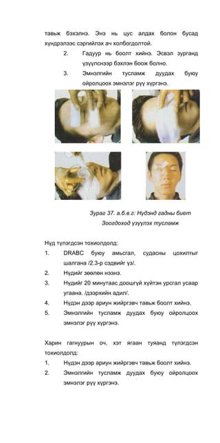 тавьж бэхэлнэ. Энэ нь цус алдах болон бусад
хүндрэлээс сэргийлэх ач холбогдолтой.
2. Гадуур нь боолт хийнэ. Эсвэл зурганд
үзүүлснээр бэхлэн боож болно.
3. Эмнэлгийн тусламж дуудах буюу
ойролцоох эмнэлэг рүү хүргэнэ.
Зураг 37. а.б.в.г: Нүдэнд гадны биет
Зоогдоход үзүүлэх тусламж
Нүд түлэгдсэн тохиолдолд:
1. DRABC буюу амьсгал, судасны цохилтыг
шалгана /2.3-р сэдвийг үз/.
2. Нүдийг зөөлөн нээнэ.
3. Нүдийг 20 минутаас доошгүй хүйтэн урсгал усаар
угаана. /дээрхийн адил/.
4. Нүдэн дээр ариун жийргэвч тавьж боолт хийнэ.
5. Эмнэлгийн тусламж дуудах буюу ойролцоох
эмнэлэг рүү хүргэнэ.
Харин гагнуурын оч, хэт ягаан туяанд түлэгдсэн
тохиолдолд:
1. Нүдэн дээр ариун жийргэвч тавьж боолт хийнэ.
2. Эмнэлгийн тусламж дуудах буюу ойролцоох
эмнэлэг рүү хүргэнэ.
 