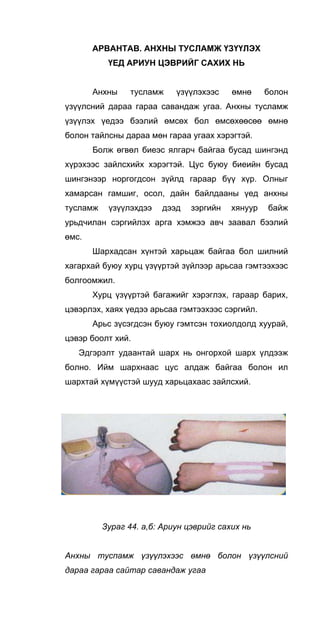 АРВАНТАВ. АНХНЫ ТУСЛАМЖ ҮЗҮҮЛЭХ
ҮЕД АРИУН ЦЭВРИЙГ САХИХ НЬ
Анхны тусламж үзүүлэхээс өмнө болон
үзүүлсний дараа гараа савандаж угаа. Анхны тусламж
үзүүлэх үедээ бээлий өмсөх бол өмсөхөөсөө өмнө
болон тайлсны дараа мөн гараа угаах хэрэгтэй.
Болж өгвөл биеэс ялгарч байгаа бусад шингэнд
хүрэхээс зайлсхийх хэрэгтэй. Цус буюу биеийн бусад
шингэнээр норгогдсон зүйлд гараар бүү хүр. Олныг
хамарсан гамшиг, осол, дайн байлдааны үед анхны
тусламж үзүүлэхдээ дээд зэргийн хянуур байж
урьдчилан сэргийлэх арга хэмжээ авч заавал бээлий
өмс.
Шархадсан хүнтэй харьцаж байгаа бол шилний
хагархай буюу хурц үзүүртэй зүйлээр арьсаа гэмтээхээс
болгоомжил.
Хурц үзүүртэй багажийг хэрэглэх, гараар барих,
цэвэрлэх, хаях үедээ арьсаа гэмтээхээс сэргийл.
Арьс зүсэгдсэн буюу гэмтсэн тохиолдолд хуурай,
цэвэр боолт хий.
Эдгэрэлт удаантай шарх нь онгорхой шарх үлдээж
болно. Ийм шархнаас цус алдаж байгаа болон ил
шархтай хүмүүстэй шууд харьцахаас зайлсхий.
Зураг 44. а,б: Ариун цэврийг сахих нь
Анхны туспамж үзүүлэхээс өмнө болон үзүүлсний
дараа гараа сайтар савандаж угаа
 
