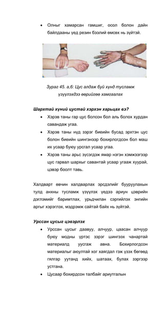 • Олныг хамарсан гамшиг, осол болон дайн
байлдааны үед резин бээлий өмсөх нь зүйтэй.
Зураг 45. а,б: Цус алдаж буй хүнд тусламж
үзүүлэхдээ өөрийгөө хамгаалах
Шархтай хүний цустай хэрхэн харьцах вэ?
• Хэрэв таны гар цус болсон бол аль болох хурдан
савандаж угаа.
• Хэрэв таны нүд зэрэг биеийн бусад эрхтэн цус
болон биеийн шингэнээр бохирлогдсон бол маш
их усаар буюу урсгал усаар угаа.
• Хэрэв таны арьс зүсэгдэж ямар нэгэн хэмжээгээр
цус гарвал шархыг савантай усаар угааж хуурай,
цэвэр боолт тавь.
Халдварт өвчин халдварлах эрсдэлийг бууруулахын
тулд анхны тусламж үзүүлэх үедээ ариун цэврийн
дэглэмийг баримтлах, урьдчилан сэргийлэх энгийн
аргыг хэрэглэх, мэдрэмж сайтай байх нь зүйтэй.
Урссан цусыг цэвэрлэх
• Урссан цусыг даавуу, алчуур, цаасан алчуур
буюу модны үртэс зэрэг шингээх чанартай
материалд уусгаж авна. Бохирлогдсон
материалыг аюултай хог хаягдал гэж үзэх бөгөөд
гялгар уутанд хийх, шатаах, булах зэргээр
устгана.
• Цусаар бохирдсон талбайг ариутгалын
 