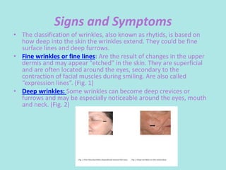 Signs and Symptoms
• The classification of wrinkles, also known as rhytids, is based on
how deep into the skin the wrinkles extend. They could be fine
surface lines and deep furrows.
• Fine wrinkles or fine lines: Are the result of changes in the upper
dermis and may appear "etched" in the skin. They are superficial
and are often located around the eyes, secondary to the
contraction of facial muscles during smiling. Are also called
“expression lines”. (Fig. 1)
• Deep wrinkles: Some wrinkles can become deep crevices or
furrows and may be especially noticeable around the eyes, mouth
and neck. (Fig. 2)
 