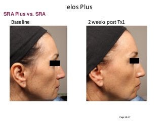 Baseline 2 weeks post Tx1
SRA Plus vs. SRA
Page 18-27
elos Plus
 