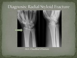 AKA: Chauffeur’s Fracture