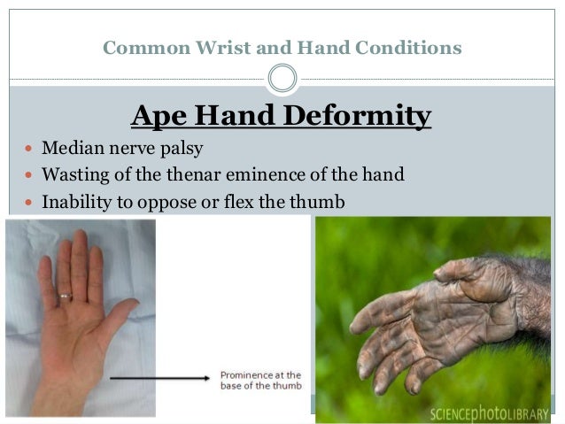 RA hand deformities
