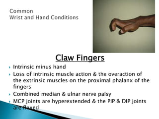 Wristand hand-2.pptx