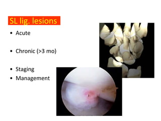 SL lig. lesions
• Acute

                    •Δυναμική Αζηάθεια
• Chronic (>3 mo)
                    •Σηαηική Αζηάθεια
                    •Αρθρίηιδα (SLAC)
• Staging
• Management
 