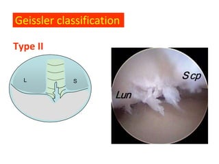 Geissler classification

Type II

  L         S
 