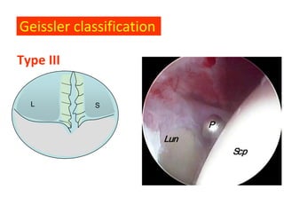 Geissler classification

Type III

  L         S
 