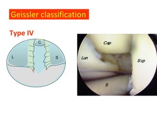 Geissler classification

Type IV
          C


L             S
 