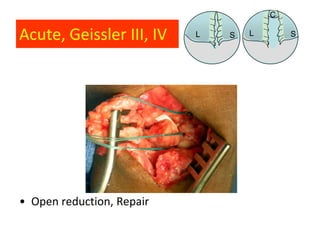 C

Acute, Geissler III, IV    L   S   L       S




• Open reduction, Repair
 