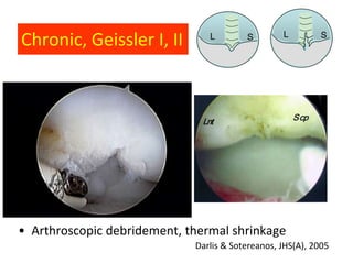 Chronic, Geissler I, II         L        S        L         S




• Arthroscopic debridement, thermal shrinkage
                             Darlis & Sotereanos, JHS(A), 2005
 