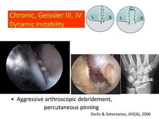 C
Chronic, Geissler III, IV     L       S      L          S
Dynamic Instability




• Aggressive arthroscopic debridement,
            percutaneous pinning
                             Darlis & Sotereanos, JHS(A), 2006
 