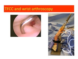 TFCC and wrist arthroscopy
 