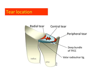 Tear location

           Radial tear          Central tear

                                               Peripheral tear)



                                               Deep bundle
                                               of TFCC

            radius
                                         Volar radioulnar lig.
                         ulna
 