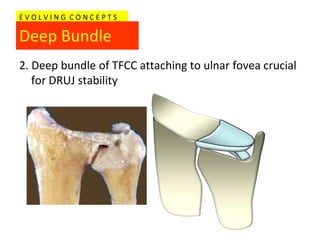 EVOLVING CONCEPTS

Deep Bundle
2. Deep bundle of TFCC attaching to ulnar fovea crucial
   for DRUJ stability
 