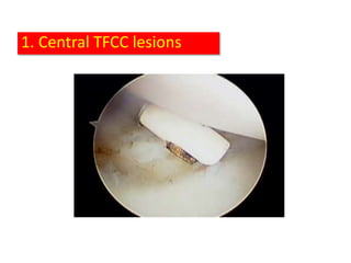 1. Central TFCC lesions
 