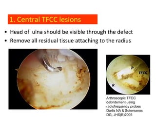 1. Central TFCC lesions
• Head of ulna should be visible through the defect
• Remove all residual tissue attaching to the radius




                                                Arthroscopic TFCC
                                                debridement using
                                                radiofrequency probes
                                                Darlis NA & Sotereanos
            Darlis & Sotereanos, JHS(A), 2005   DG, JHS(B)2005
 