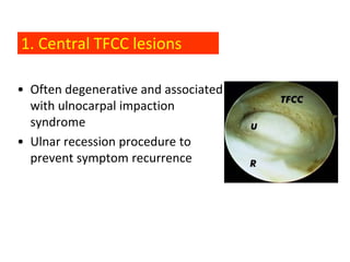1. Central TFCC lesions

• Often degenerative and associated
  with ulnocarpal impaction
  syndrome
• Ulnar recession procedure to
  prevent symptom recurrence
 