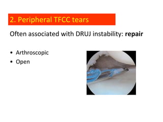 2. Peripheral TFCC tears
Often associated with DRUJ instability: repair

• Arthroscopic
• Open
 