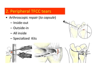 2. Peripheral TFCC tears
• Arthroscopic repair (to capsule)
   – Inside-out
   – Outside-in
   – All inside
   – Specialized Kits
 