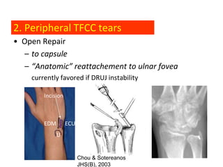 2. Peripheral TFCC tears
• Open Repair
  – to capsule
  – “Anatomic” reattachement to ulnar fovea
    currently favored if DRUJ instability

        Incision



        EDM        ECU
              U


                         Chou & Sotereanos
                         JHS(B), Chou, Sarris, Sotereanos, JHS(B), 2003
                                 2003
 