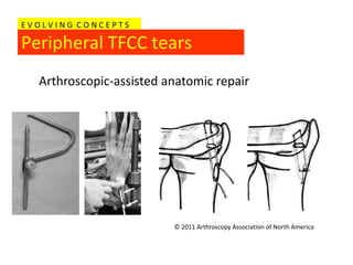 EVOLVING CONCEPTS

Peripheral TFCC tears
  Arthroscopic-assisted anatomic repair




                         © 2011 Arthroscopy Association of North America
 