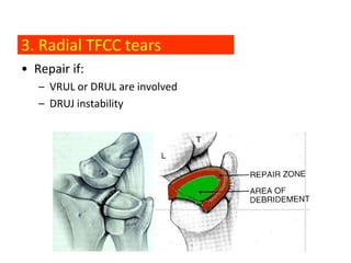 3. Radial TFCC tears
• Repair if:
   – VRUL or DRUL are involved
   – DRUJ instability
 