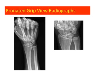 Pronated Grip View Radiographs
 