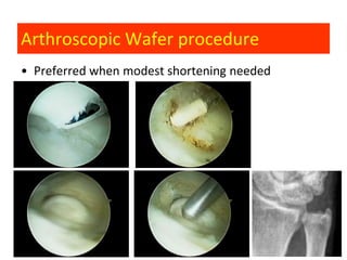 Arthroscopic Wafer procedure
• Preferred when modest shortening needed
 