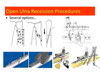 Open Ulna Recession Procedures
• Several options…
 