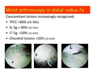 Wrist arthroscopy in distal radius Fx
Concomitant lesions increasingly recognized:
• ΤFCC ≈60% (43-78%)
• SL lig.≈ 40% (32-75%)
• LT lig. ≈20% (15-61%)
• Chondral lesions ≈20% (19-32%)
 