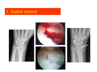 1. Radial styloid
 