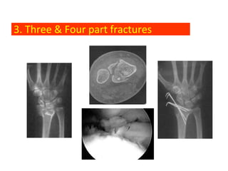 3. Three & Four part fractures
 