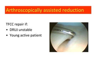 Arthroscopically assisted reduction

TFCC repair if:
• DRUJ unstable
• Young active patient
 