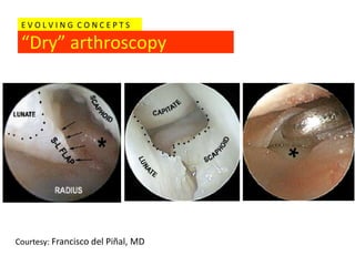 EVOLVING CONCEPTS

 “Dry” arthroscopy




Courtesy: Francisco del Piñal, MD
 