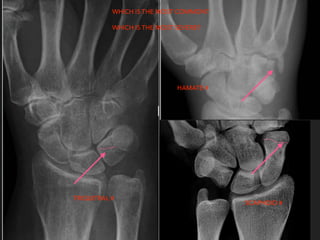 TRIQUITRAL #
HAMATE #
SCAPHOID #
WHICH IS THE MOST COMMON?
WHICH IS THE MOST SEVERE?
 