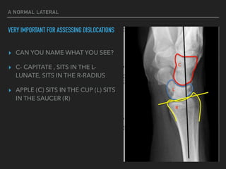 A NORMAL LATERAL
VERY IMPORTANT FOR ASSESSING DISLOCATIONS
▸ CAN YOU NAME WHAT YOU SEE?
▸ C- CAPITATE , SITS IN THE L-
LUNATE, SITS IN THE R-RADIUS
▸ APPLE (C) SITS IN THE CUP (L) SITS
IN THE SAUCER (R)
C
L
R
 