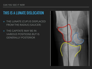 CAN YOU SEE IT NOW
THIS IS A LUNATE DISLOCATION
▸ THE LUNATE (CUP) IS DISPLACED
FROM THE RADIUS (SAUCER)
▸ THE CAPITATE MAY BE IN
VARIOUS POSITIONS BUT IS
GENERALLY POSTERIOR
 