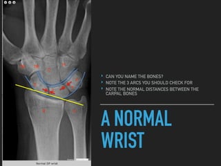 A NORMAL
WRIST
‣ CAN YOU NAME THE BONES?
‣ NOTE THE 3 ARCS YOU SHOULD CHECK FOR
‣ NOTE THE NORMAL DISTANCES BETWEEN THE
CARPAL BONES
S
L
T
P
R U
TR TR
C
H
 