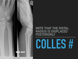 COLLES #
NOTE THAT THE DISTAL
RADIUS IS DISPLACED
POSTERIORLY
 