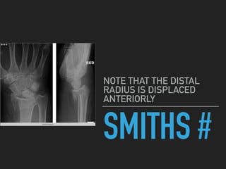 SMITHS #
NOTE THAT THE DISTAL
RADIUS IS DISPLACED
ANTERIORLY
 