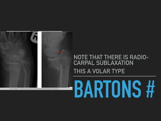 BARTONS #
NOTE THAT THERE IS RADIO-
CARPAL SUBLAXATION
THIS A VOLAR TYPE
 