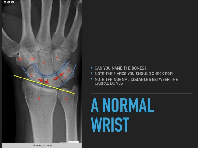 Wrist Fractures Pdf